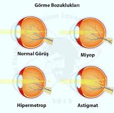Göz Bozuklukları Genetik Midir? Anneden Babadan mı Geçiyor? Hangi Göz Bozukları Genetiktir?