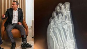 CHP Genel Başkanı Özgür Özel, ayağının kırılmasıyla ilgili tartışmalara son