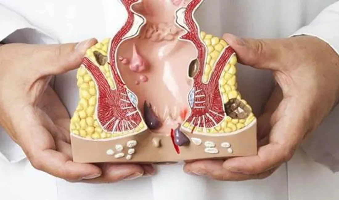 Basur nedir? Hemoroidin nedenleri, belirtileri ve tedavi yöntemlerini öğrenin. Doğal
