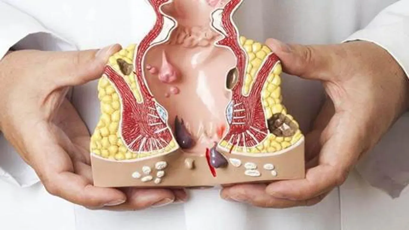 Basur nedir? Hemoroidin nedenleri, belirtileri ve tedavi yöntemlerini öğrenin. Doğal