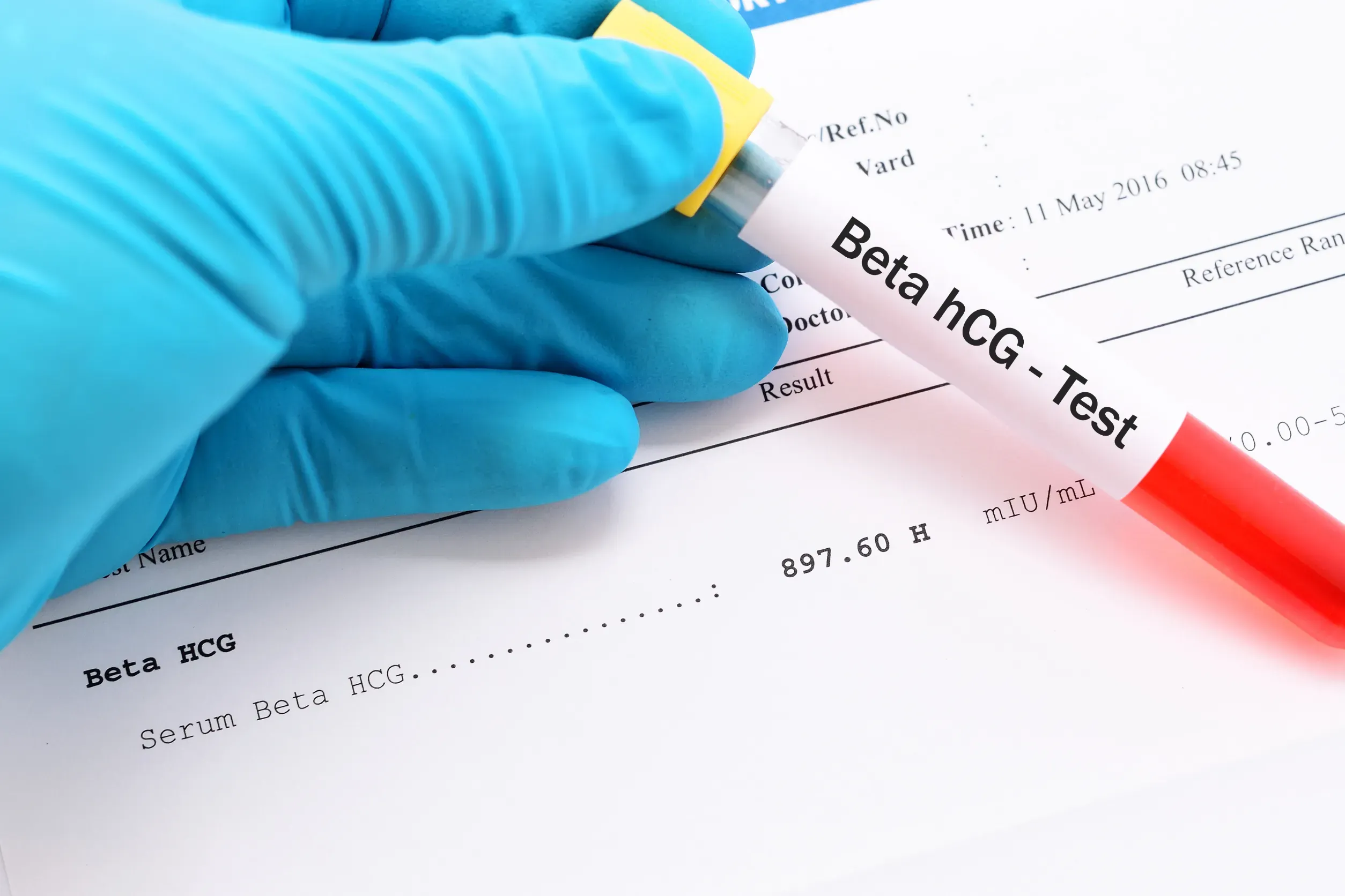 Beta HCG Nedir? Beta HCG kaç olursa hamiledir, kaç olmalı? Beta HCG kaç olursa negatif olur? Hamile olmayan birinde Beta HCG değeri kaç olur?