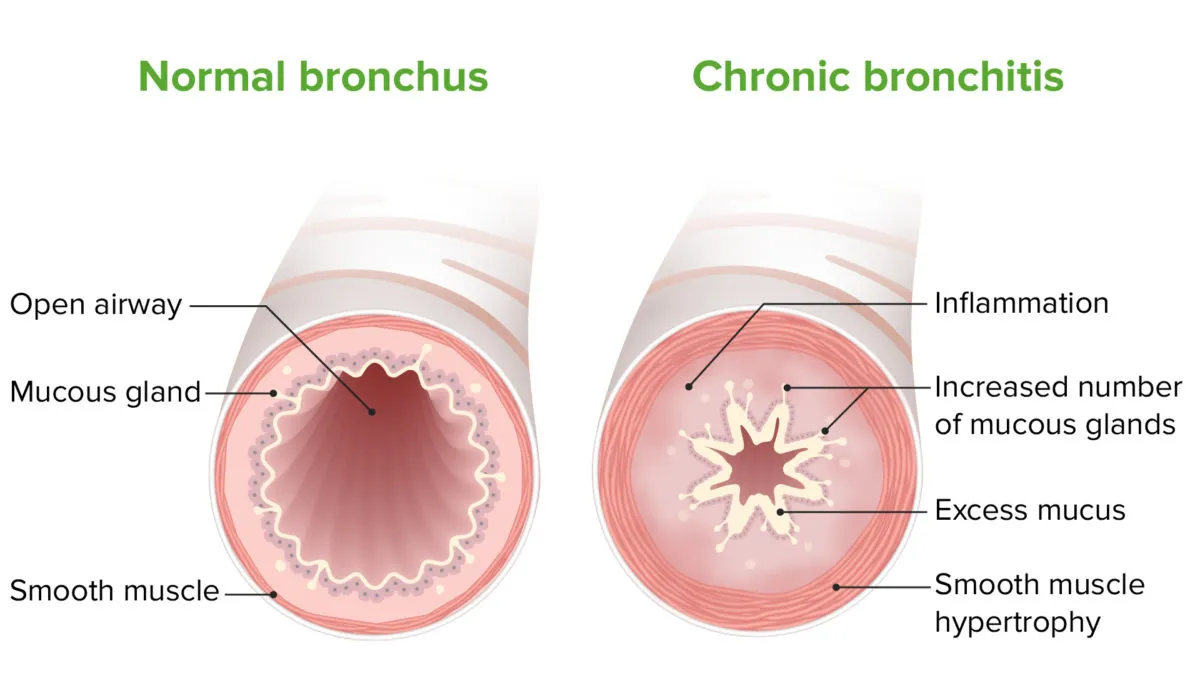 Bronşit Nedir? Solunum Yollarının Sessiz Düşmanı Bronşit ciddi bir şey mi, ne yapmalı, kaç gün sürer, nereye vurur?