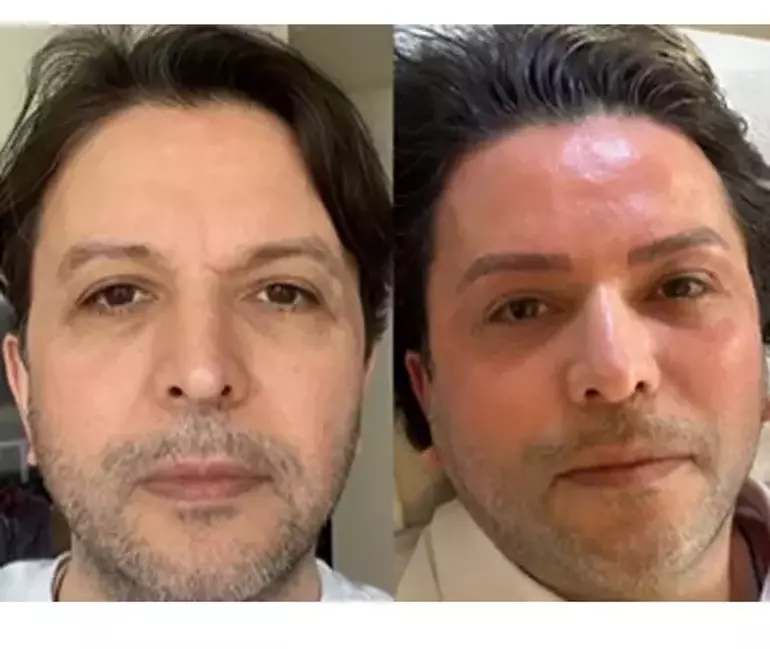 Nihat Doğan Estetikle Tanınmaz Hale Geldi! Yeni Yüzü Görenleri Şoke Etti