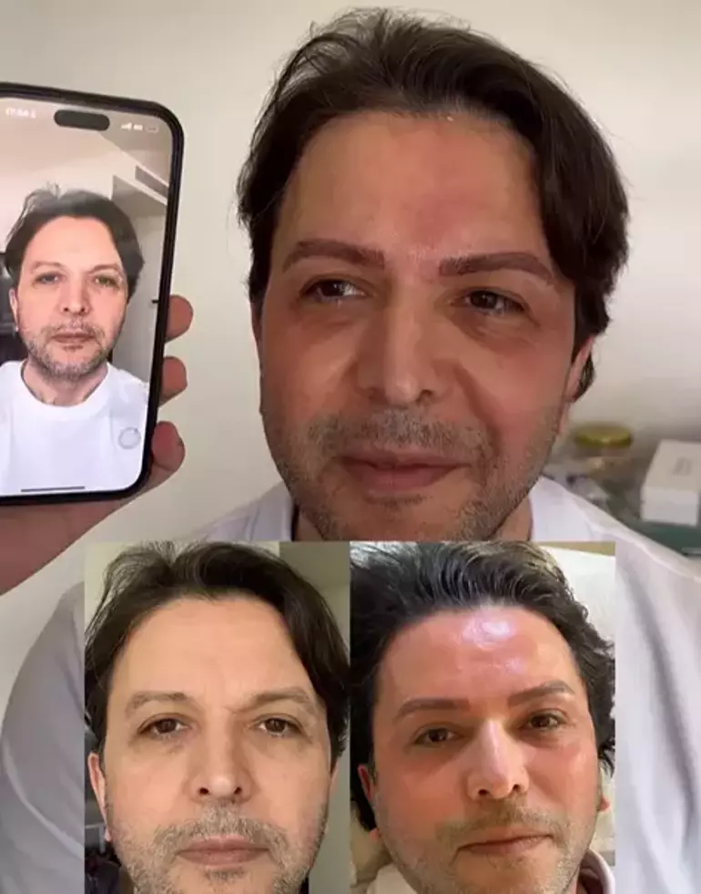 Nihat Doğan Estetikle Tanınmaz Hale Geldi! Yeni Yüzü Görenleri Şoke Etti