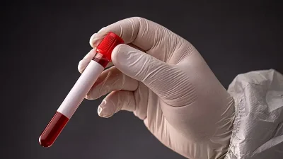 Amilaz yüksekliği neyin belirtisidir? Hangi değerden sonra tehlikelidir ve nasıl