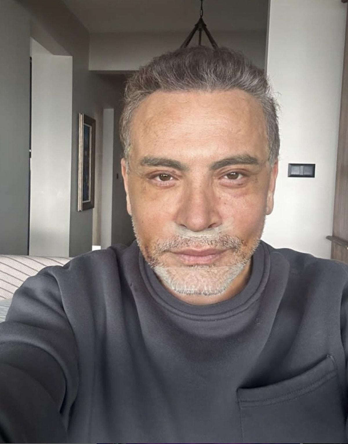 Cenk Eren'in Gerçek Adı Yüksel Venedik mi? Cenk Eren Estetikli mi, Yüzüne Ne Yaptırdı?