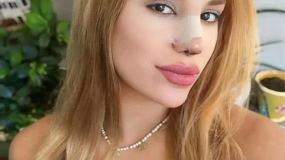 Survivor All Star 2025’ten diskalifiye edilen Almeda Baylan, burun estetiği