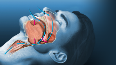 Uyku apnesi ne demek? Nefesiniz uykuda duruyorsa dikkat! Uyku apnesinin