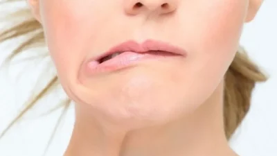 Yüz felci neden olur, belirtileri nelerdir ve yüz felci kaç