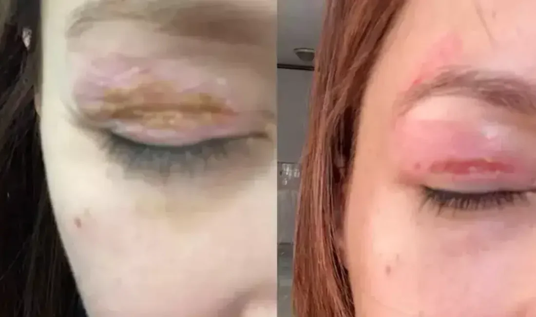 Diyarbakır’da yaşayan 28 yaşındaki Elif T., uygun fiyatlı güzellik operasyonu