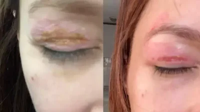 Diyarbakır’da yaşayan 28 yaşındaki Elif T., uygun fiyatlı güzellik operasyonu