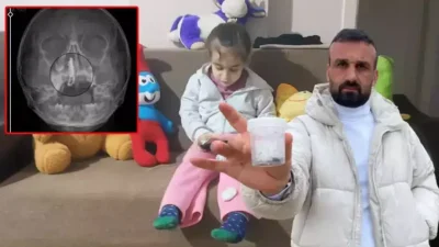 Rize’de şiddetli burun kanaması şikayetiyle hastaneye götürülen 5 yaşındaki Polen