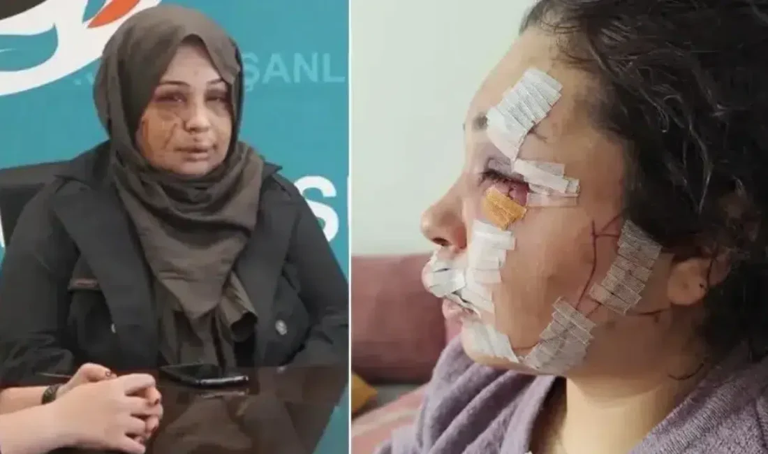 Ankara’da boşanma aşamasındaki eşine tırnak makasıyla saldırarak yüzünde kalıcı hasar