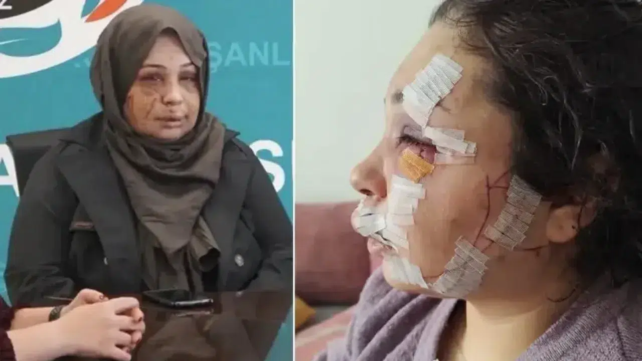 Ankara’da boşanma aşamasındaki eşine tırnak makasıyla saldırarak yüzünde kalıcı hasar