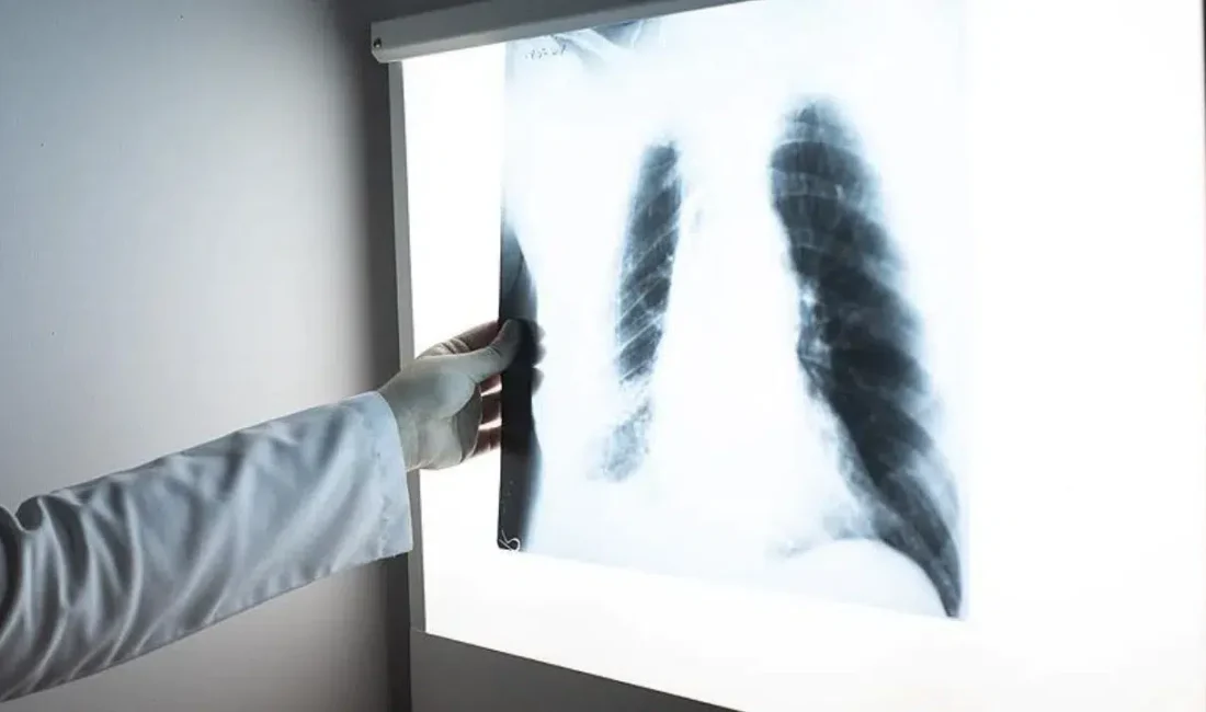 Sağlık Bakanlığı tarafından kararlılıkla yürütülen Ulusal Tüberküloz Kontrol Programı meyvelerini