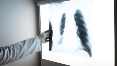 Sağlık Bakanlığı tarafından kararlılıkla yürütülen Ulusal Tüberküloz Kontrol Programı meyvelerini