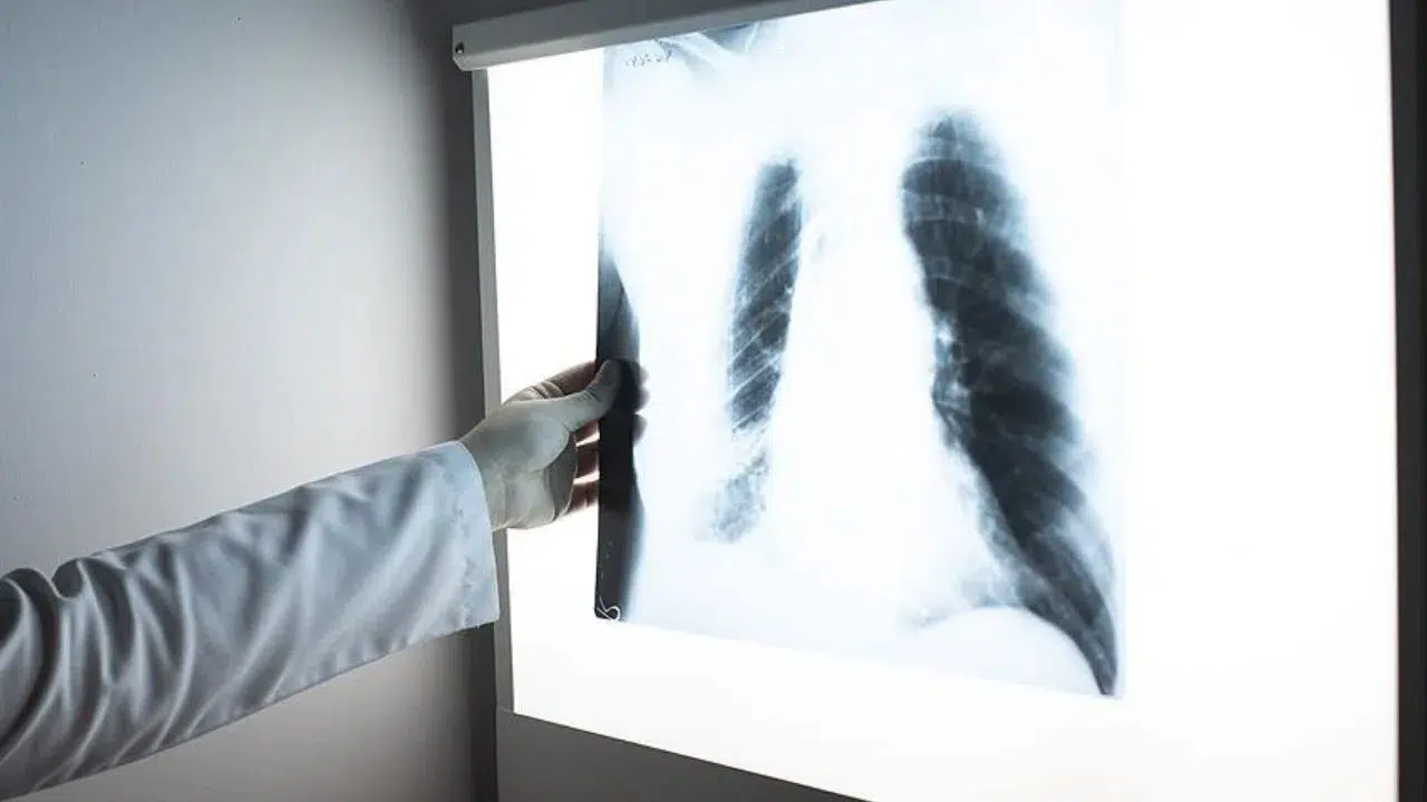 Sağlık Bakanlığı tarafından kararlılıkla yürütülen Ulusal Tüberküloz Kontrol Programı, Türkiye’de