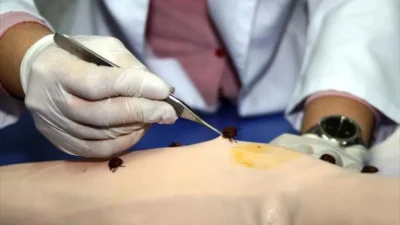 Yozgat’ın Sorgun ilçesinde kene tutunması sonrası rahatsızlanan ve Kırım Kongo